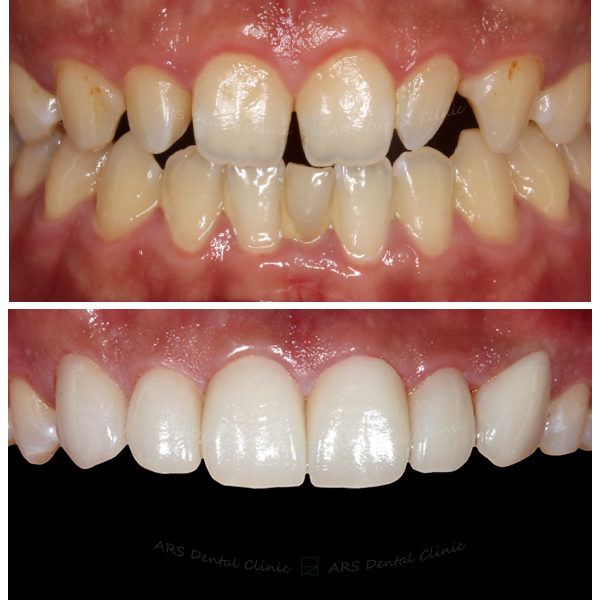 Z-C.L.S#13#23&全瓷冠#13-#23 (7523) G