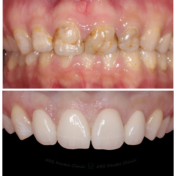 Z-C.L.S#14-#24&全瓷冠#14-#25 (4949) G