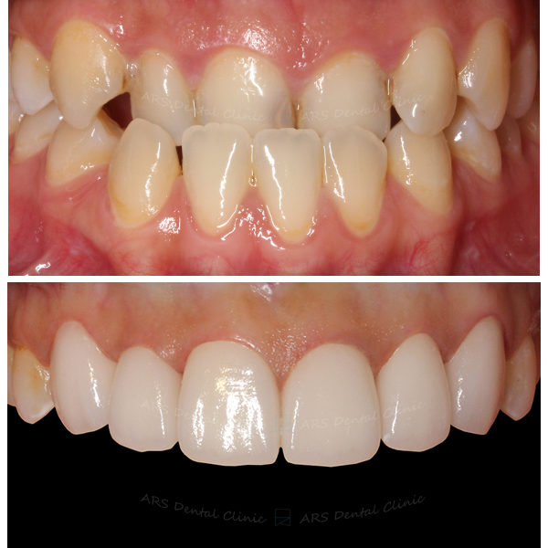 Q-ortho+Veneer+全瓷冠#13-#23 (3822) G