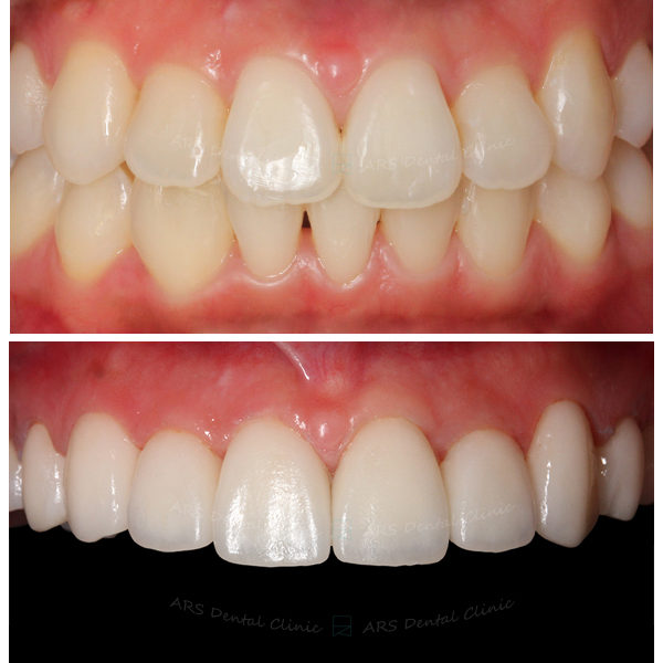 Z-Veneer#14-#24 (1799) G