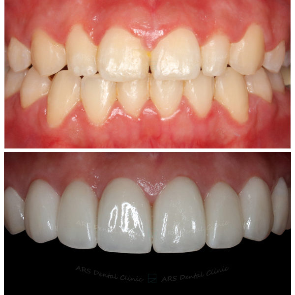 J-C.L.S#14-#25+Veneer#14-#24 (10480) G