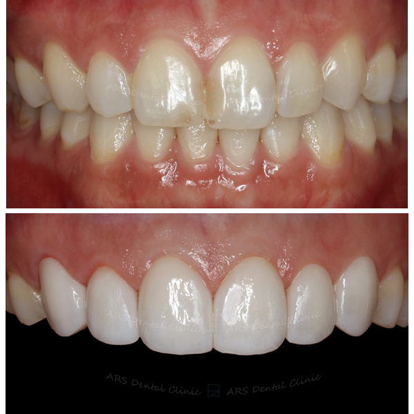 Q-Veneer#13-#23 (12901) G