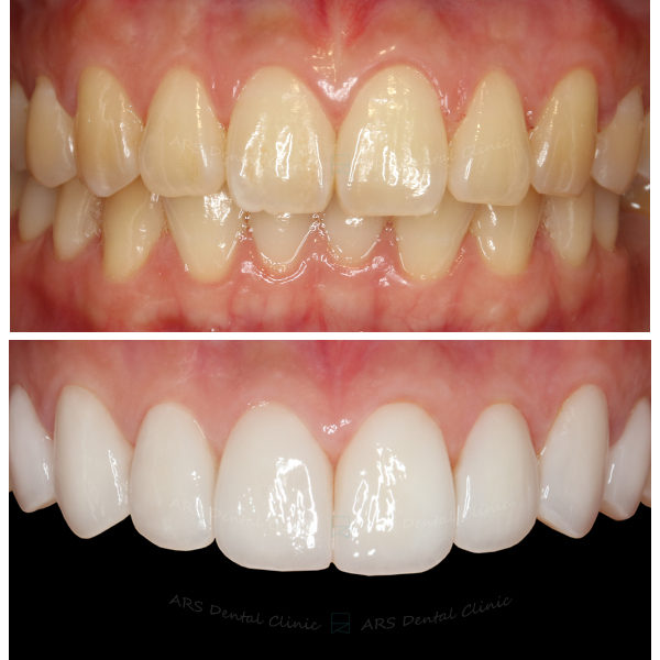 Q-Veneer#14-#24 (13115) G