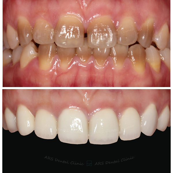 Q-Veneer#14-#24 (2209) G