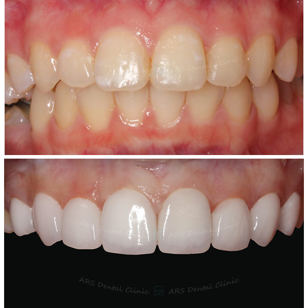 Q-Veneer#14-#24 (3432) G