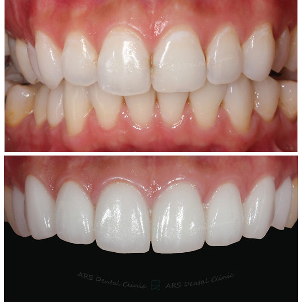 Q-Veneer#14-#24 (4395) G