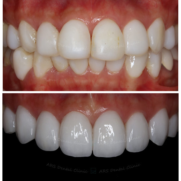 Q-Veneer#14-#24 (6589) G