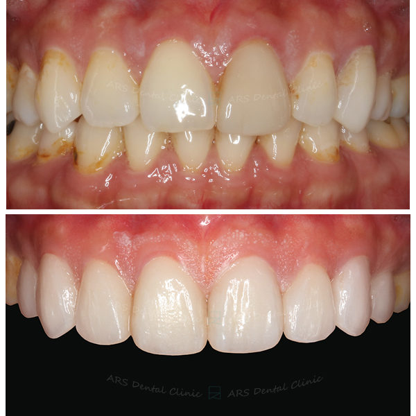 Q-Veneer#14-#24 (9239) G