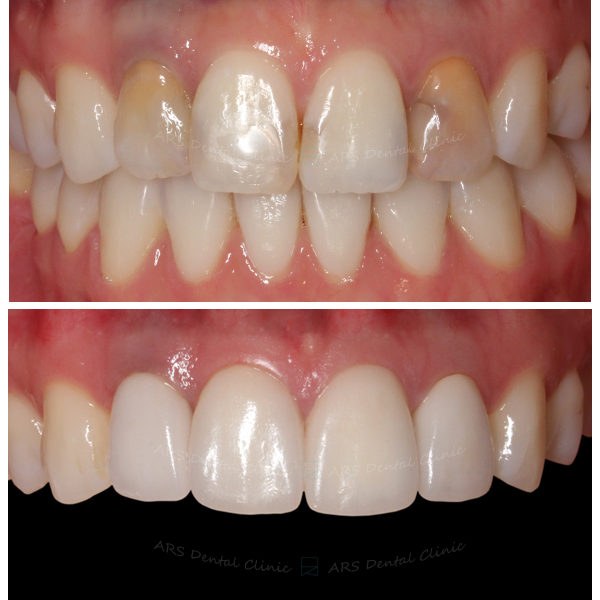 Q-Veneer+全瓷冠#12-#22 (3111) G