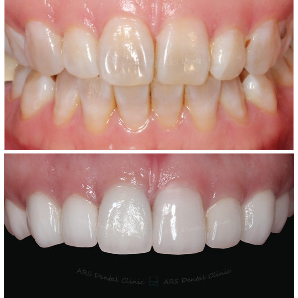 Q-Veneer+全瓷冠#14-#24 (3381) G