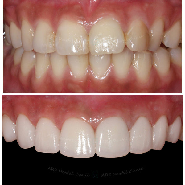 Q-Veneer+全瓷冠#14-#24 (3454) G