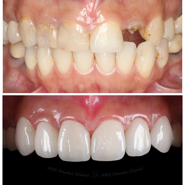 V-CLS+Veneer+全瓷冠#13-#23 (11225) G