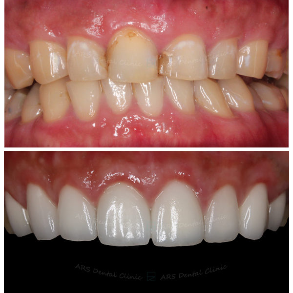 Z-CLS+Veneer+全瓷冠#14-#24 (5184) G