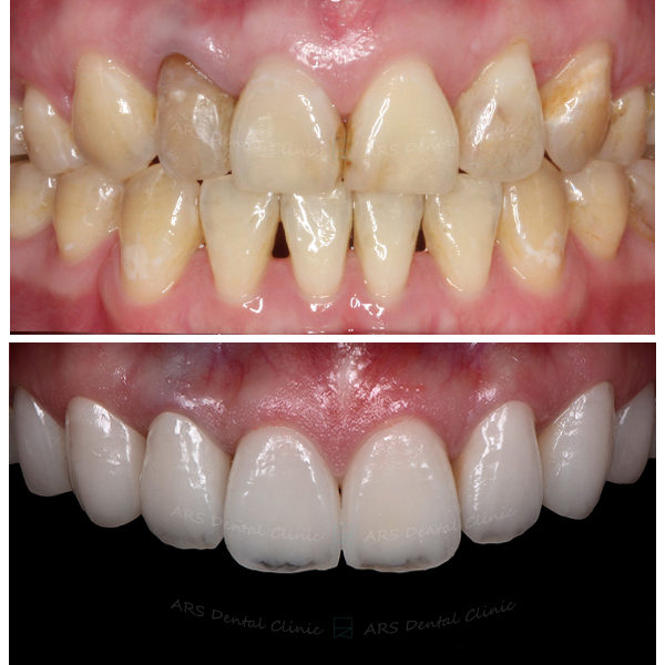 Q-CLS+Veneer+全瓷冠#14-#24 (5937) G