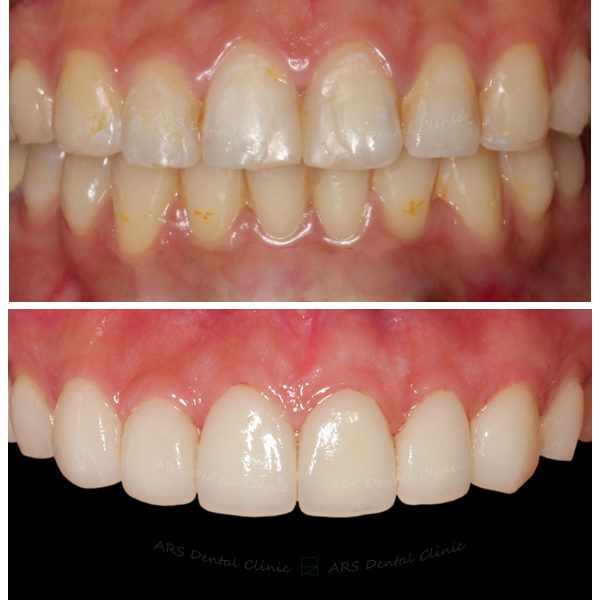 Q-Veneer#13-#23 (3317) G