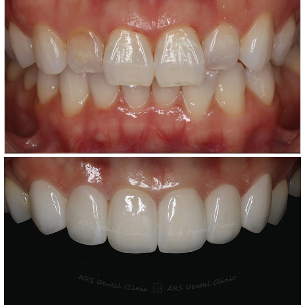 Q-Veneer+全瓷冠#13-#23 (12486) G