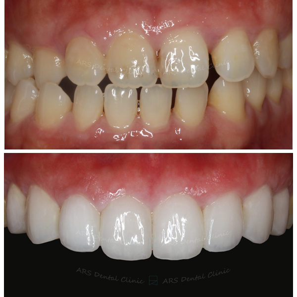 Q-Veneer+全瓷冠#14-#24 (13088) G