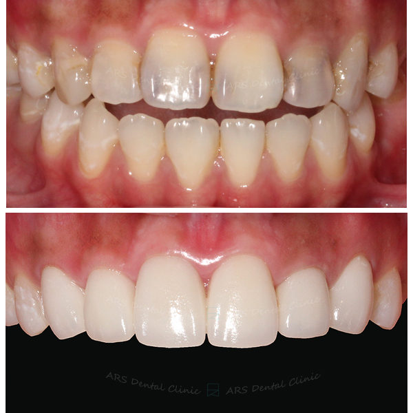 Q-全瓷冠#13-#23 (2770) G