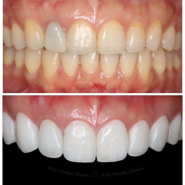 Q-全瓷冠#14-#24 (11094) G