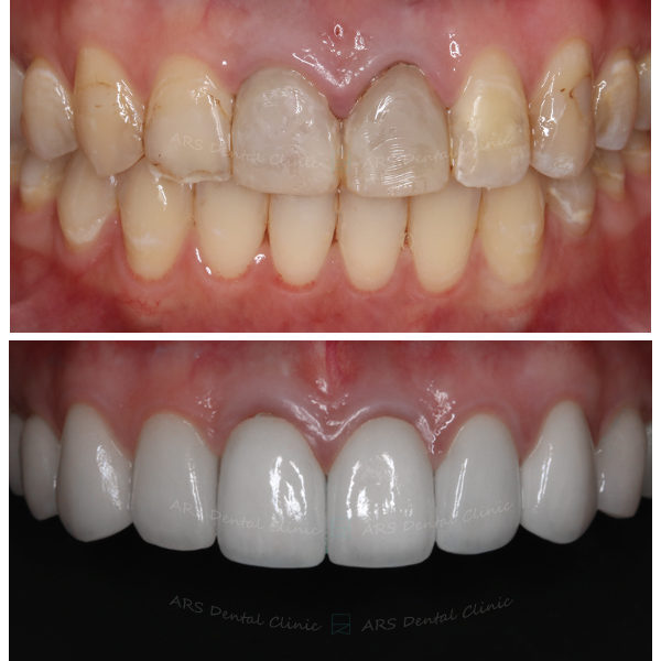 Z-C.L.S#14-#24&全瓷冠#14-#24 (6877) G