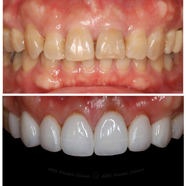 Z-CLS+Veneer+全瓷冠#14-#24 (12075) G