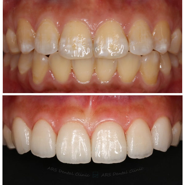 Z-Veneer#13-#23 (5468) G