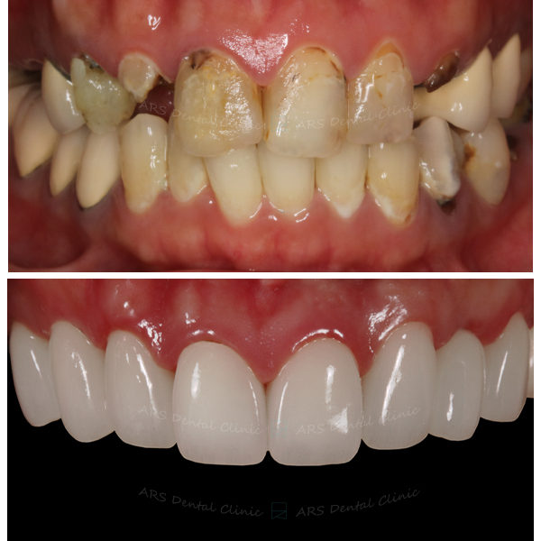 Z-全瓷冠#14-24 (8264) G
