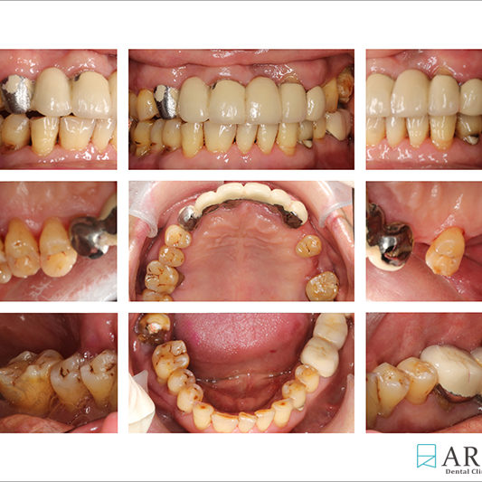 800533) Z-Perio術後照 (7989)