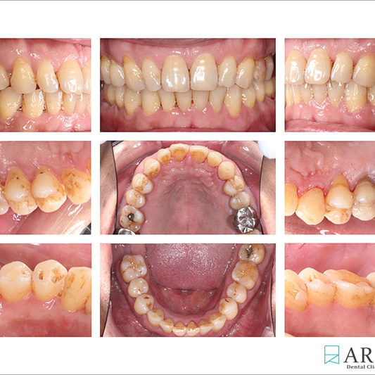 800533) C-Perio術後照 (8709)