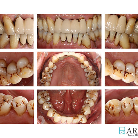 800533) Z-Perio術後照 (13133)