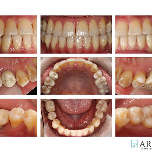 800533) Z-Perio術後照 (7758)