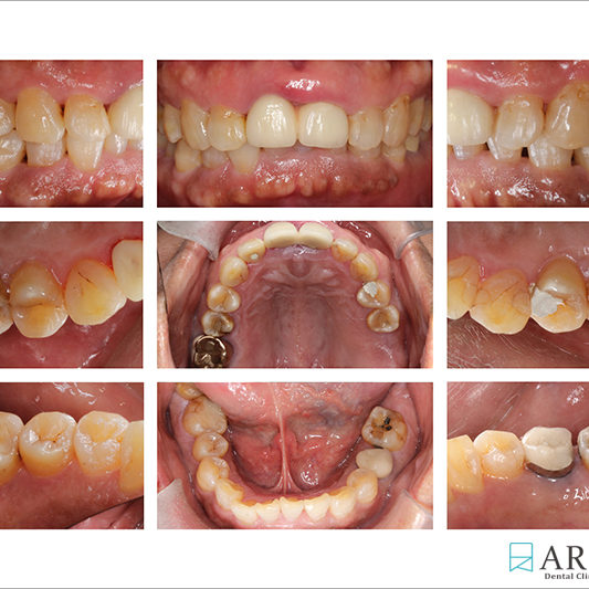 800533) Z-Perio術後照 (7893)