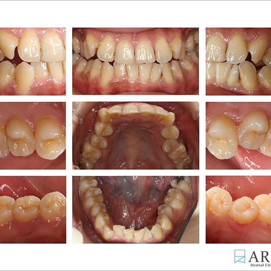 800533) Z-Perio術後照 (8168)