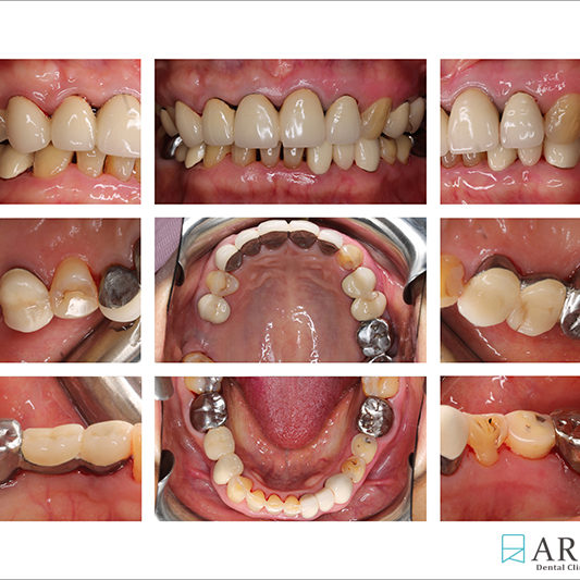 800533) Z-Perio術後照 (8471)