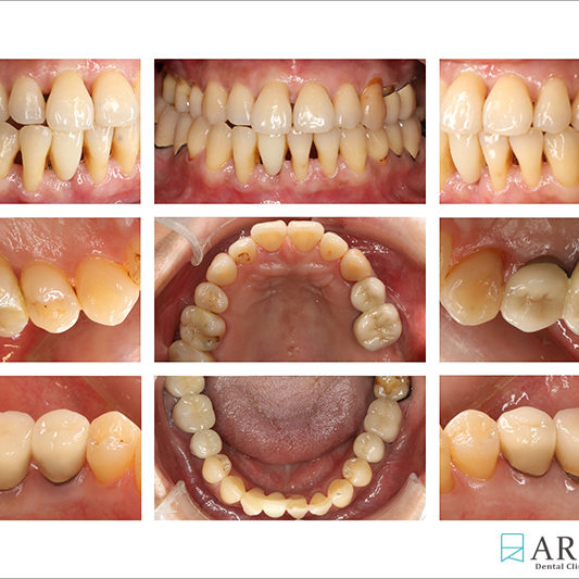 800533) Z-Perio術後照 (9069)