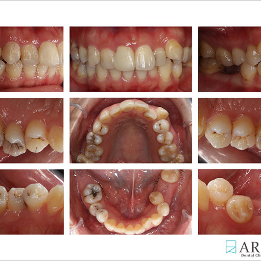 800533) Z-Perio術後照 (9217)