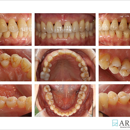 800533) Z-Perio術後照 (9603)
