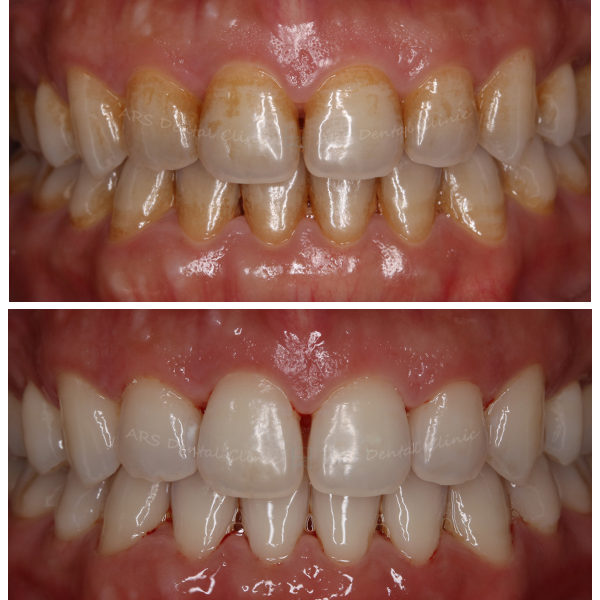 C-噴砂美白+冷光美白 (4160)G