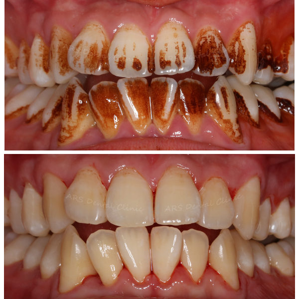 H-噴砂美白 (12845)G