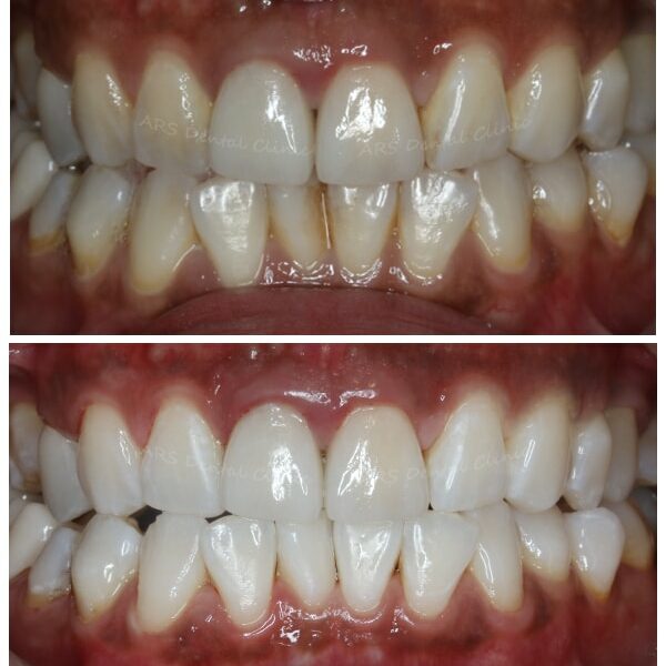 Q-噴砂美白+冷光美白 (10383)G √