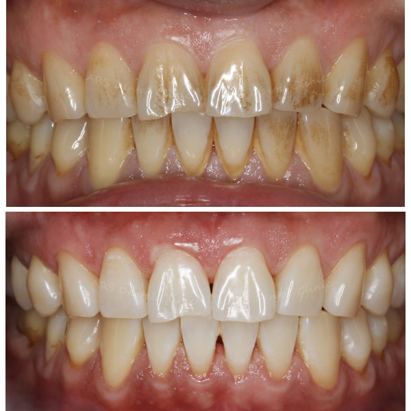 Q-噴砂美白+冷光美白 (13447)G