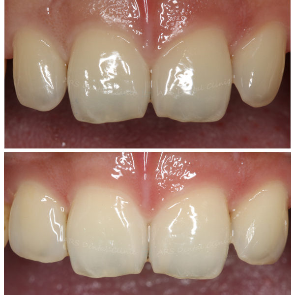 W-美觀OD #12#22 (13221)