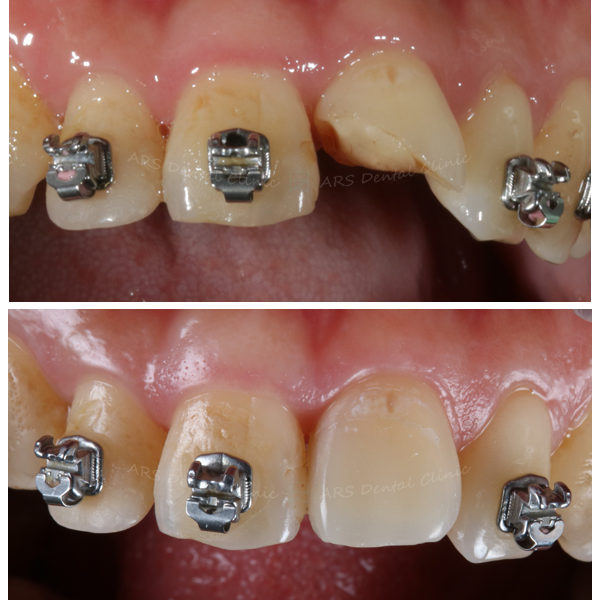 W-美觀OD #21 (12649)