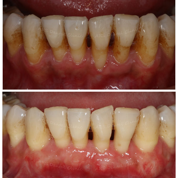 Z-CTG #33-#43 (12495)