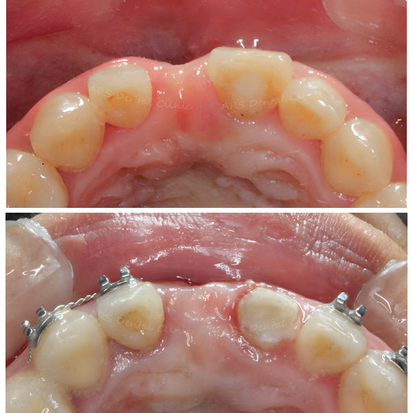 Z-FGG+GBR #11 (4730)_