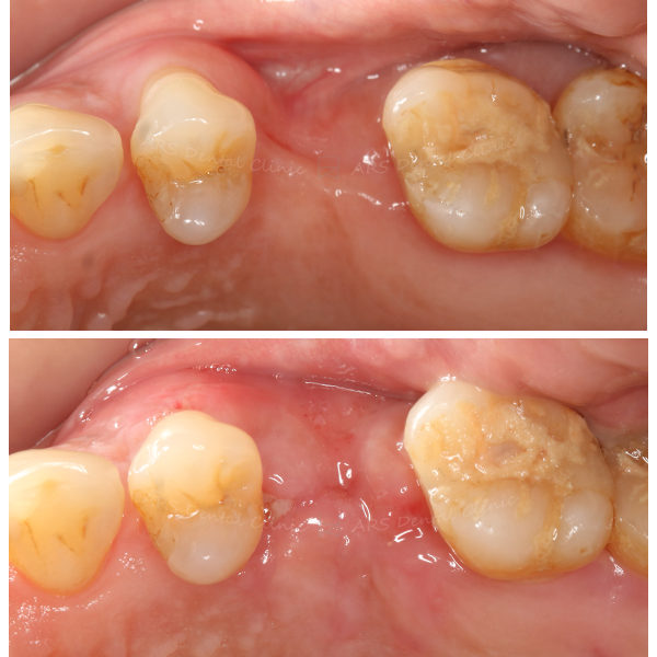 Z-GBR #14-#17 (13691)
