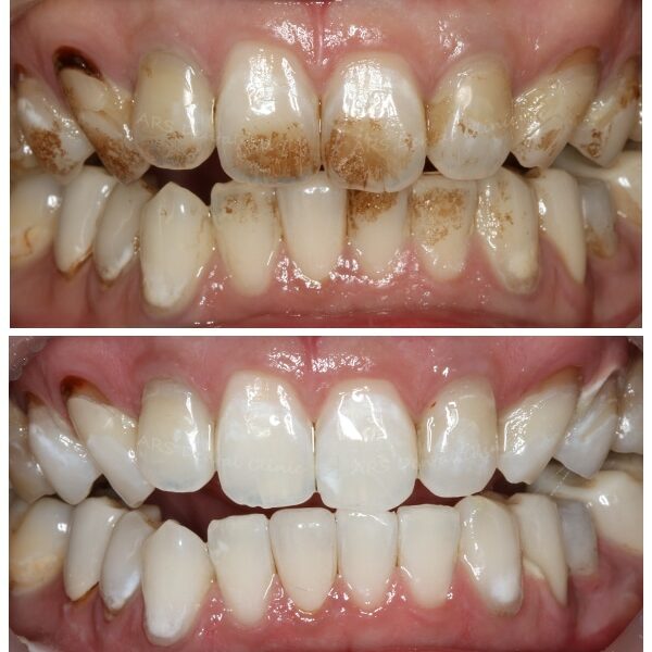 Z-噴砂美白+冷光美白 (6662)G √