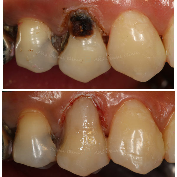 Z-美觀OD #14 (14037)