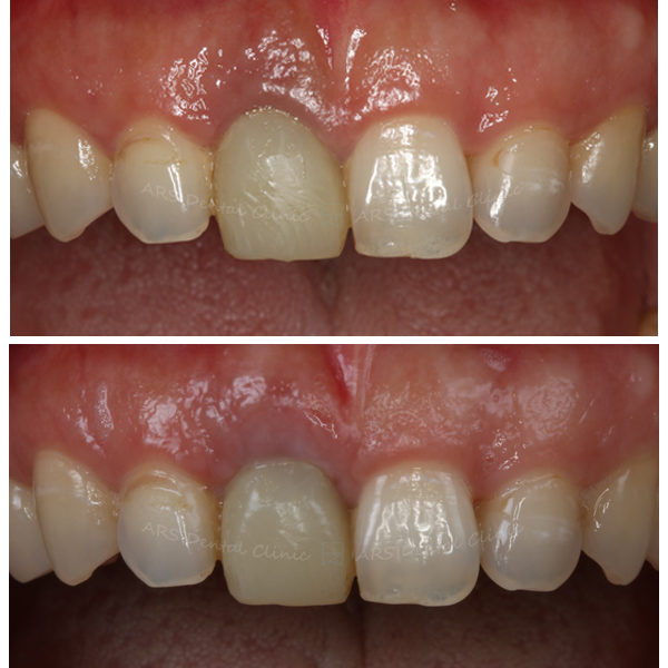 √Z-CTG #11 (13502)