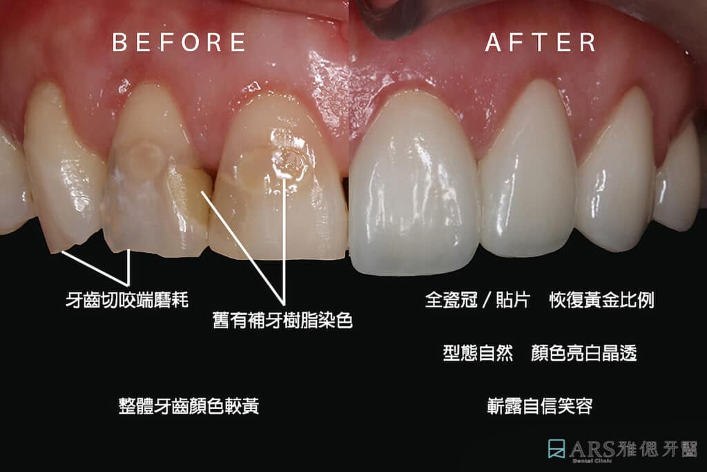 陶瓷貼片 全瓷冠 適應症